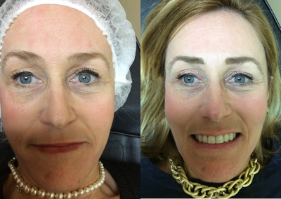 Permanent Brows - Before and After