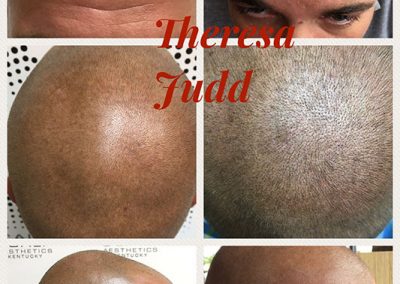 Scalp Micropigmentation - Before and After